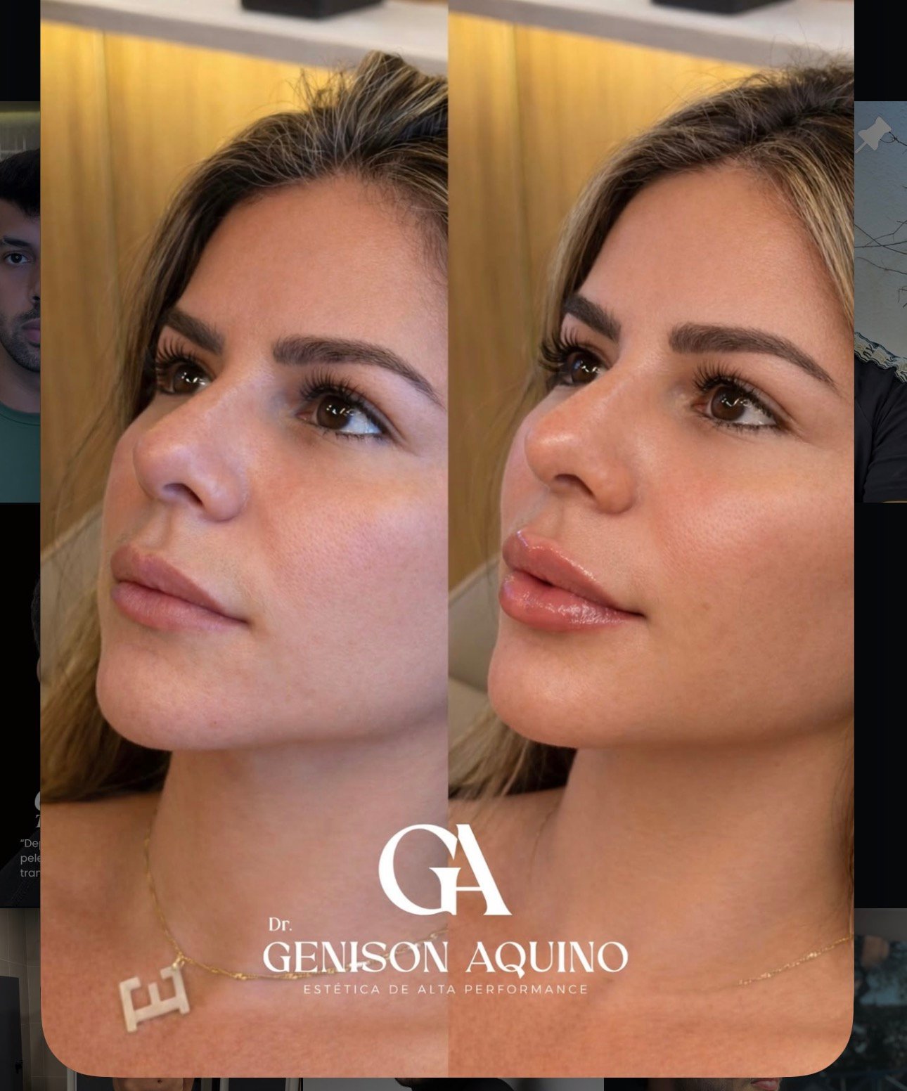 Antes e depois de paciente atendida pelo Dr. Genison Aquino, perfil do rosto