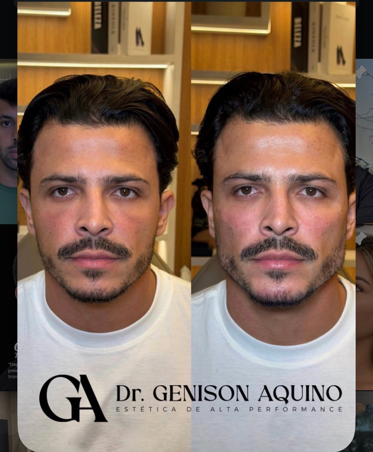Antes e depois de paciente atendido pelo Dr. Genison Aquino, rosto de frente