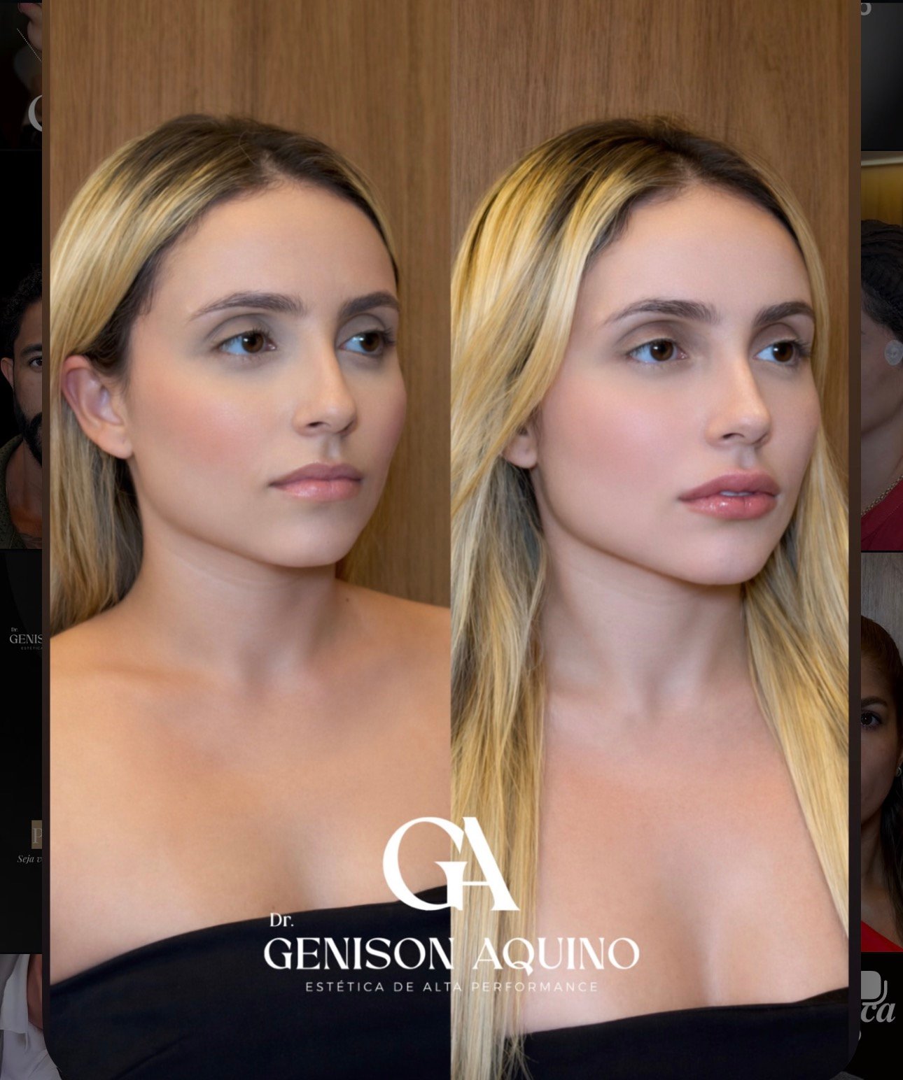 Antes e depois de paciente atendida pelo Dr. Genison Aquino, perfil do rosto